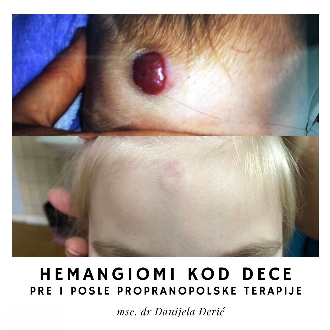 Read more about the article HEMANGIOMI KOD DECE – UZROCI, SIMPTOMI I LEČENJE